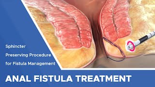 Closure of Fistula Tract with Laser [upl. by Ahtreb546]