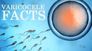 Varicocele Embolization Advantages Diagnosis Procedure Post Surgical Care [upl. by Riti]