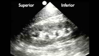 UrinaryKidney Stones  Overview signs and symptoms risk factors pathophysiology treatment [upl. by Aicilra991]