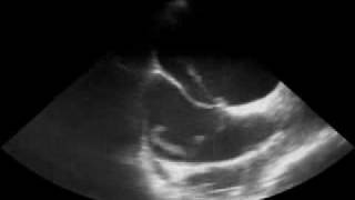 Thrombus in a Patent Foramen Ovale [upl. by Otha516]