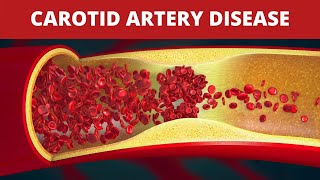 Carotid Artery Stenosis  Ultrasound  Doppler  Case 133 [upl. by Gaughan156]