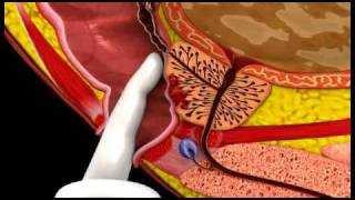 Prostate Cancer  3D Medical Animation  ABP © [upl. by Hardner]