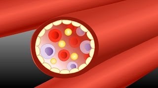 Atheroma  Pathology mini tutorial [upl. by Elburr]