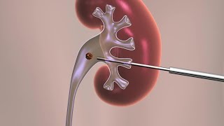 Percutaneous Nephrolithotomy [upl. by Grosvenor857]