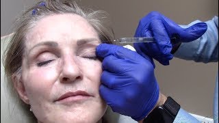 Sunken Eye Treatment  Utah Valley Dermatology [upl. by Aynotahs989]