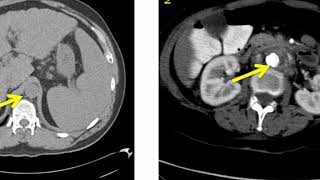 Your Radiologist Explains Myelography [upl. by Anait]