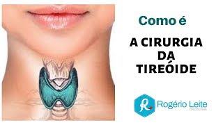 Tireoide Como É A Cirurgia Da Tireoide [upl. by Lancey]