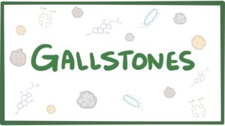 Gallstones cholelithiasis [upl. by Atinaujnas]