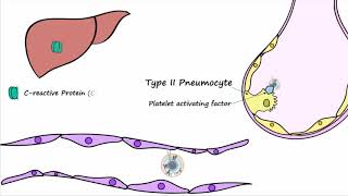 Bacterial Pneumonia  Pathogenesis [upl. by Torp]