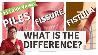 Piles  Fisure  Fistula  Difference explained  Dr Vishal Tomar  Open Consult [upl. by Leonid]