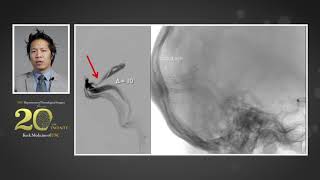 Internal Carotid Artery Route [upl. by Korry]