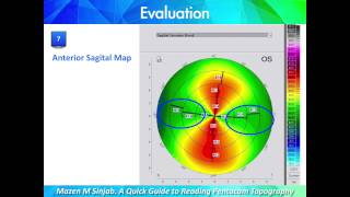 A Quick Guide to Reading Corneal Topography Part 1 [upl. by Gudren398]