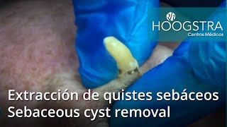 Extracción de quistes sebáceos  Sebaceous cyst removal 19013a [upl. by Llennod]