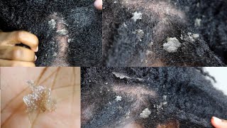 My Seborrheic Dermatitis my scalp up close [upl. by Elleirol]