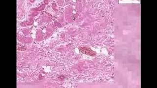 Histopathology Skin  Dry gangrene [upl. by Naitsihc]