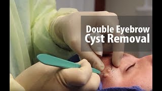 Double Eyebrow Cyst [upl. by Gala]