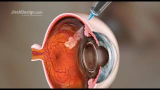 Intravitreal Injection Animation HD [upl. by Nahtnaoj]