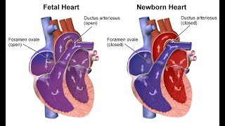 ¿Qué son las cardiopatías congénitas [upl. by Yelsnia]