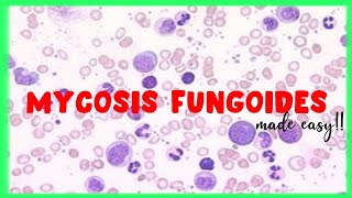 Mycosis Fungoides  WBC disorders  Sezary Syndrome [upl. by Annazus]