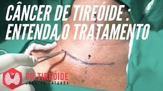 Tratamento do câncer de tireóide  Dr Jônatas Catunda [upl. by Avaria451]