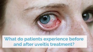 What is uveitis and what causes it [upl. by Hotchkiss]