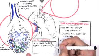 PART I  Pneumonia Overview Lobar and Bronchopneumonia [upl. by Alliuqa]