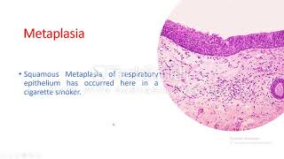 Cellular adaptation Metaplasia [upl. by Judith]