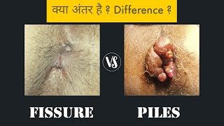 Piles vs Fissure  Difference [upl. by Edny39]