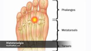 Metatarsalgia Foot Pain Causes Symptoms amp Treatments [upl. by Malloy21]