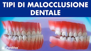 Malocclusione e tipi di malocclusione dentale © [upl. by Eldredge]