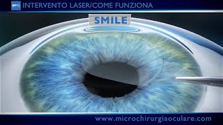 Intervento Laser Occhi Come Funziona [upl. by Ikir]