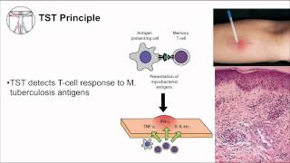 Tuberculosis Diagnosis [upl. by Idel]