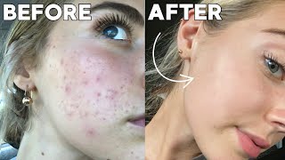 How I Cleared My Skin In 8 Weeks naturally [upl. by Gowrie]