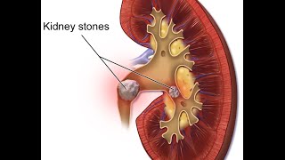 Nephrolithiasis [upl. by Angelico]