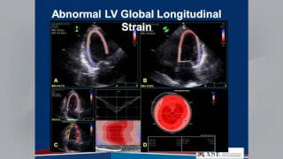 Living with Heart Failure  A Guide for Patients [upl. by Kellene312]