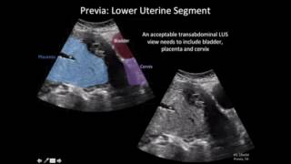 Ultrasound Diagnosis of Placenta Accreta A Tutorial for Imagers [upl. by Kiyoshi]