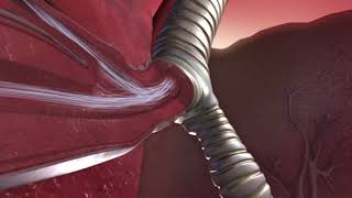 The Mechanics of an Asthma Attack An Animated Insight [upl. by Seraphine]