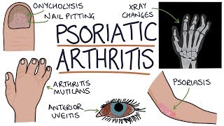 Psoriatic Arthritis [upl. by Himelman]