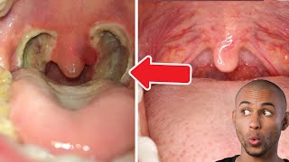 Tonsil Stone  Tonsillectomy [upl. by Willey693]