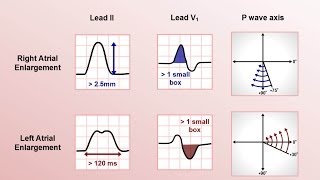 Intro to EKG Interpretation  Chamber Enlargement [upl. by Lemahs]