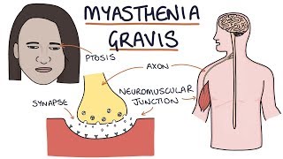 Myasthenia Gravis [upl. by Pozzy585]