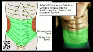 The UltrasoundGuided TAP Block [upl. by Enitsuga]