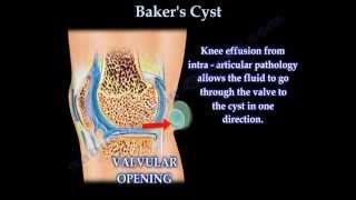 Bakers Cyst  Everything You Need To Know  Dr Nabil Ebraheim [upl. by Had]