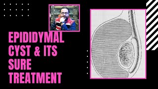 Epididymal cyst smptoms causes and treatment  Epididymal Cyst Treatment Homeopathic  in Hindi [upl. by Irolam288]