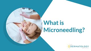 What is Microneedling  Microneedling Treatment [upl. by Dolly]