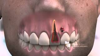 How to treat a dental Fistula [upl. by Rania]