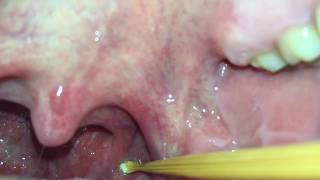 Tonsil Stone Extraction [upl. by Ruprecht]