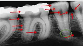 Radiographie rétro  alvéolaire [upl. by Eisserc]