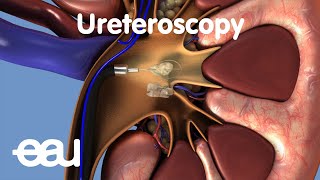 Renal Calculi  Nephrolithiasis  Kidney Stone  NCLEX Review [upl. by Nema]