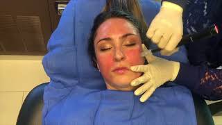 Microneedling with PRP Platelet Rich Plasma quotVampire Facialquot [upl. by Jem]